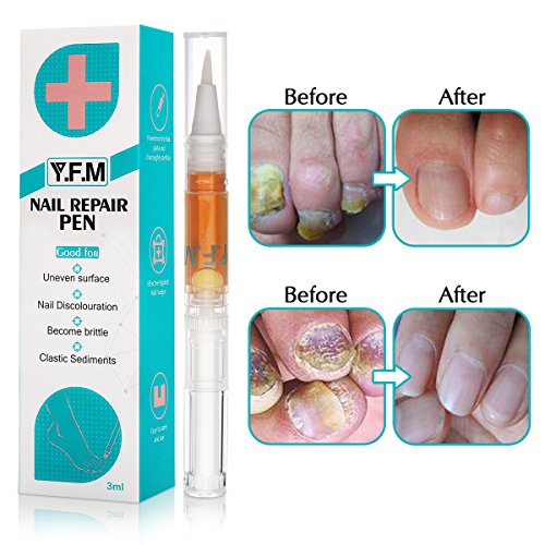 Product Cover Y.F.M Toenail Treatment, Toenail Care, Nail Treatment Pen Nail Gel, Effective Nail Treatment, Toenails & Fingernails Solution, 3 ml